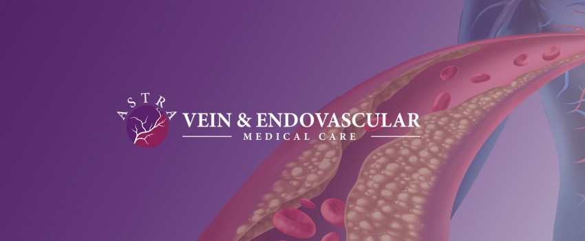 Advantages of Services in Astra Vein Treatment Center (Bronx)