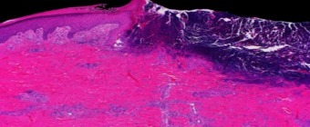 Mayo Clinic Wound Symposium: The Edges of Wound Care 2024