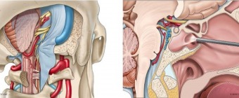 Mayo Clinic Open and Endoscopic Techniques to the Cranial Base Surgery Course 2025