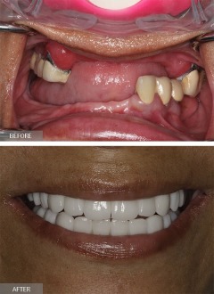 NYC Dental Implants Center offers a discount
