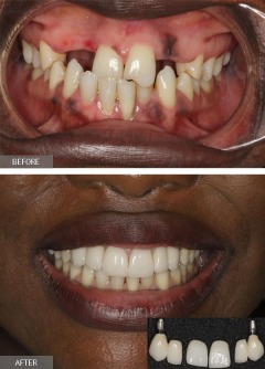 NYC Dental Implants Center offers a discount