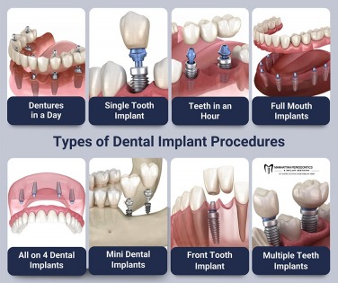 Manhattan Periodontics & Implant Dentistry offers a discount