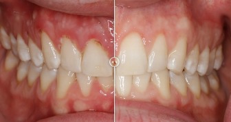 Manhattan Periodontics & Implant Dentistry offers a discount