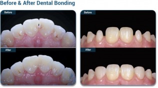 Family Cosmetic & Implant Dentistry of Brooklyn offers a discount