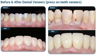Family Cosmetic & Implant Dentistry of Brooklyn offers a discount