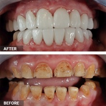 LuxDen Dental Center has a special offer for new patients.