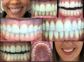 Stamford Dental Arts offers a free Invisalign consultation
