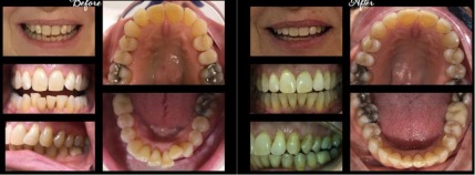 Stamford Dental Arts offers a free Invisalign consultation