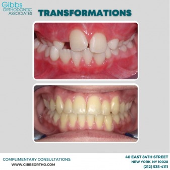 Advantages of Services in Gibbs Orthodontic Associates, P.C: Invisalign, Braces and Dentofacial Orthopedics