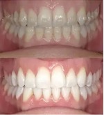 Advantages of Services in Gibbs Orthodontic Associates, P.C: Invisalign, Braces and Dentofacial Orthopedics