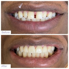 Gentle Dental in Queens offers a discount