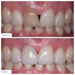 Gentle Dental in Queens offers a discount