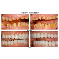 Precision Dental NYC offers a 20% discount on dental implant procedures