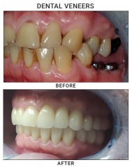 Precision Dental NYC offers a 20% discount on dental implant procedures