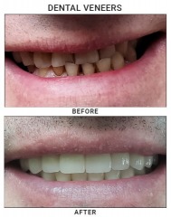 Precision Dental NYC offers a 20% discount on your first exam