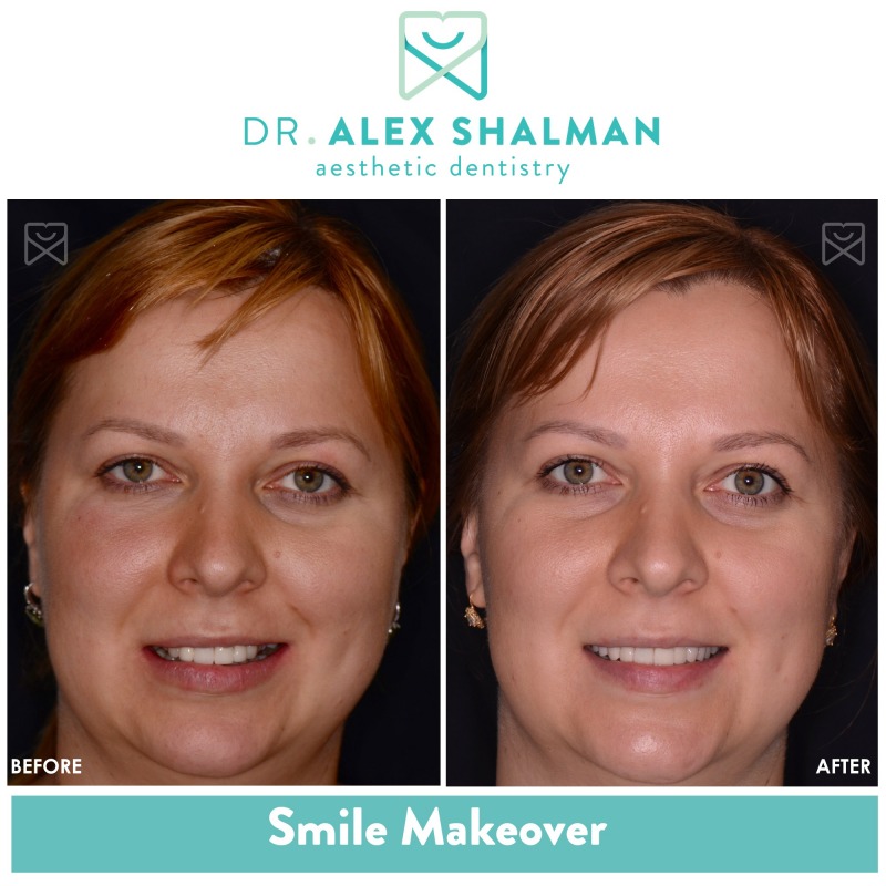 Shalman Dentistry provides dental implants