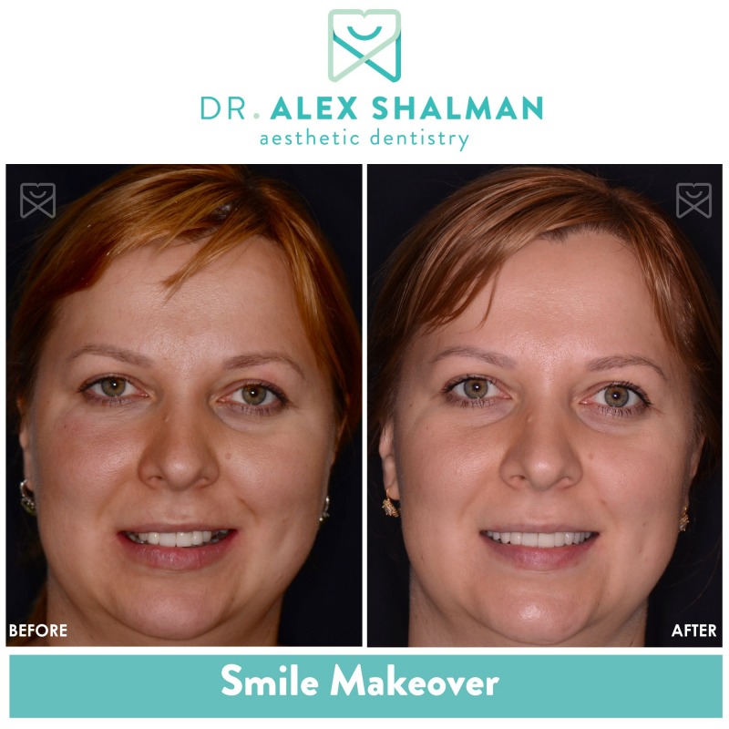 Shalman Dentistry provides dental implants