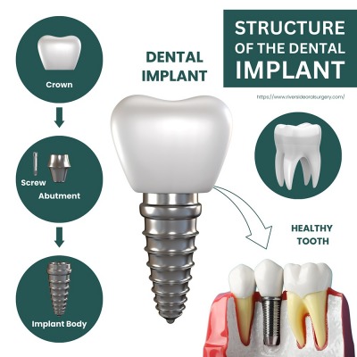 Advantages of Services in Riverside Oral Surgery