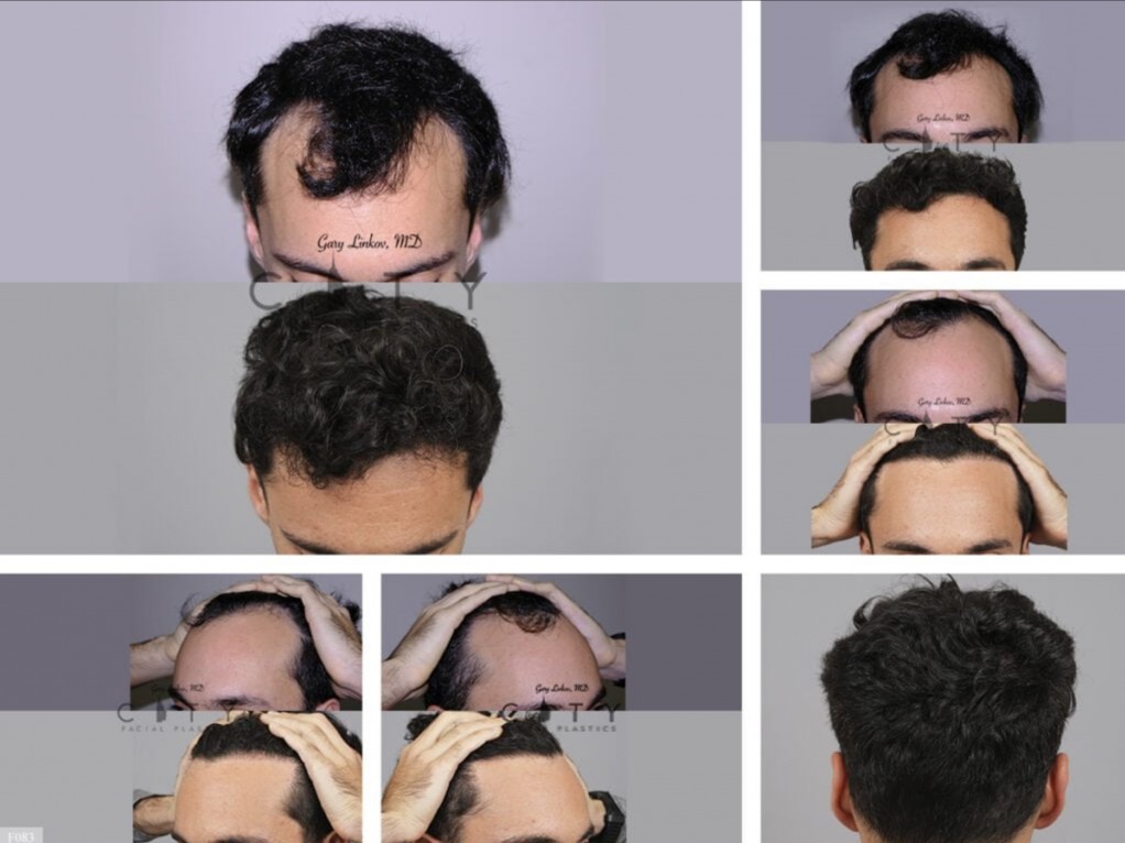 Advantages of Services in Linkov Hair Surgery