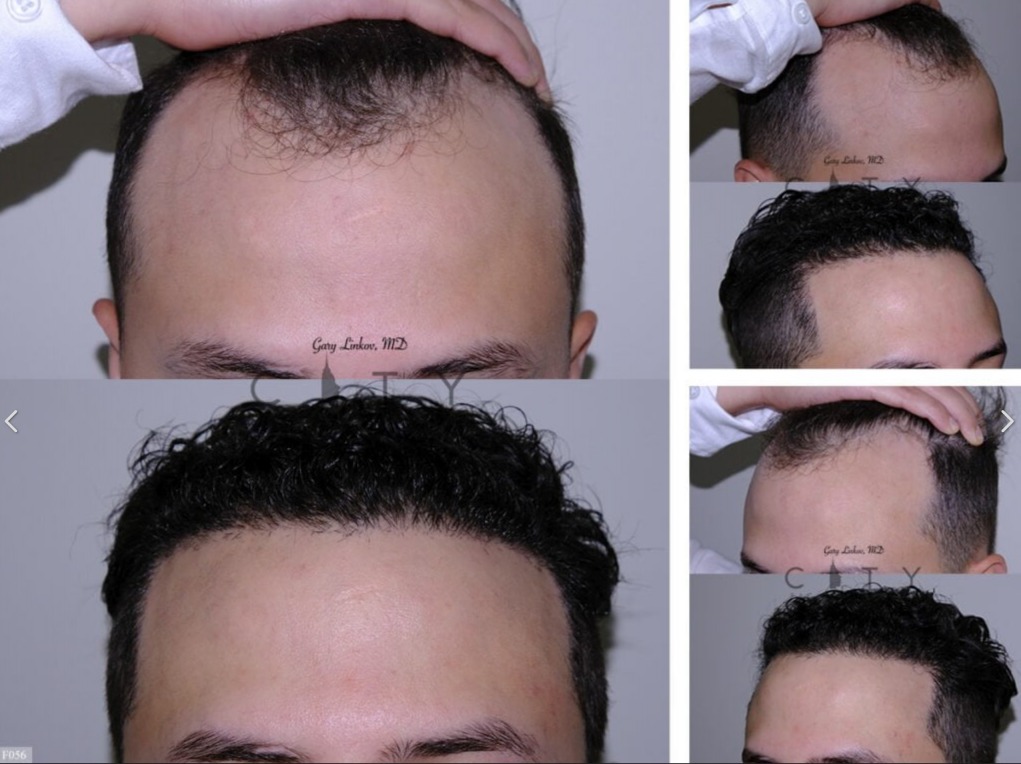 Advantages of Services in Linkov Hair Surgery