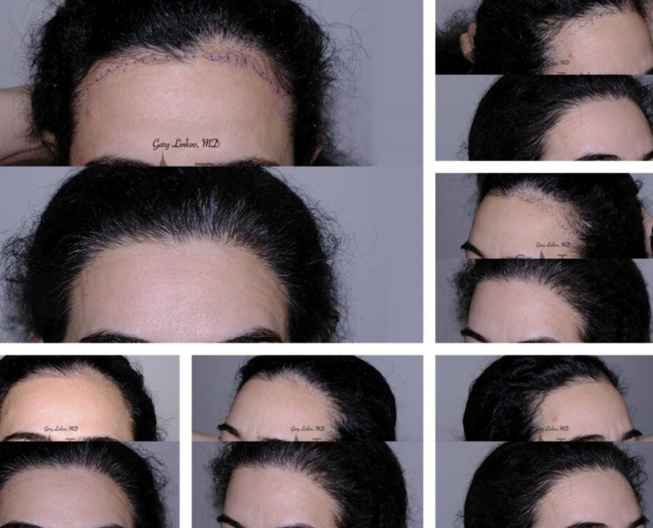 Advantages of Services in Linkov Hair Surgery