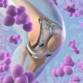 Orthopedic Infectious Diseases 2023