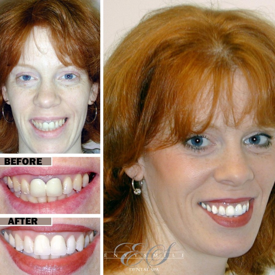 Gum Disease Treatment