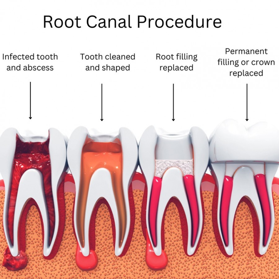 Root Canal Therapy in Brooklyn