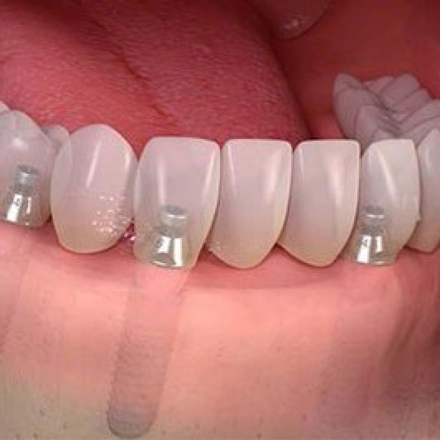 Dental Implants in the Bronx, NY