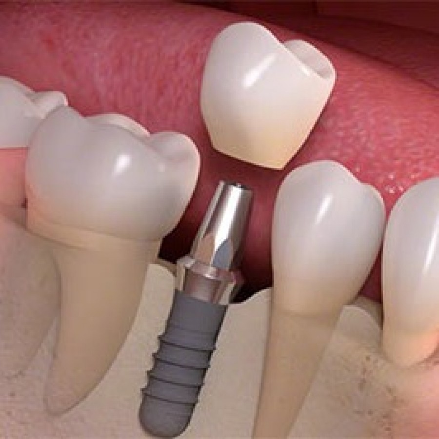 Dental Implants in the Bronx, NY