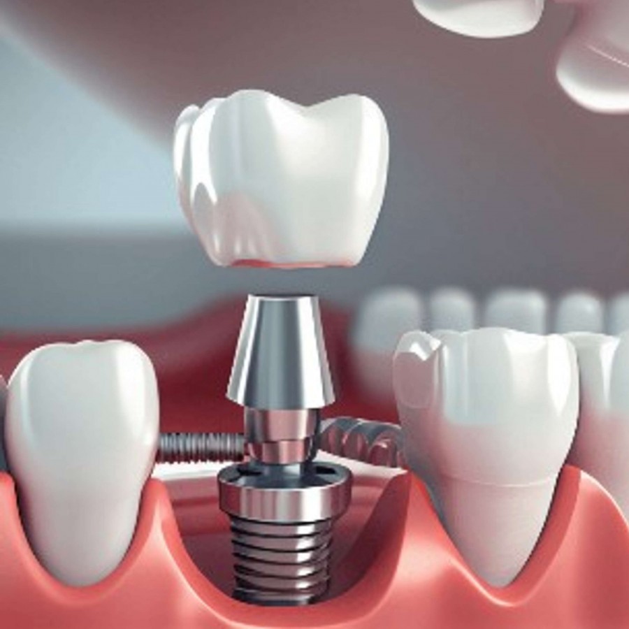 Dental Implants in Brooklyn, NY
