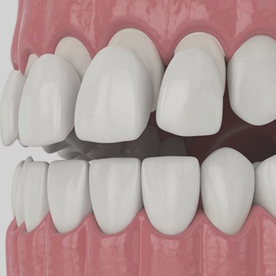Dental Veneers Stamford, CT