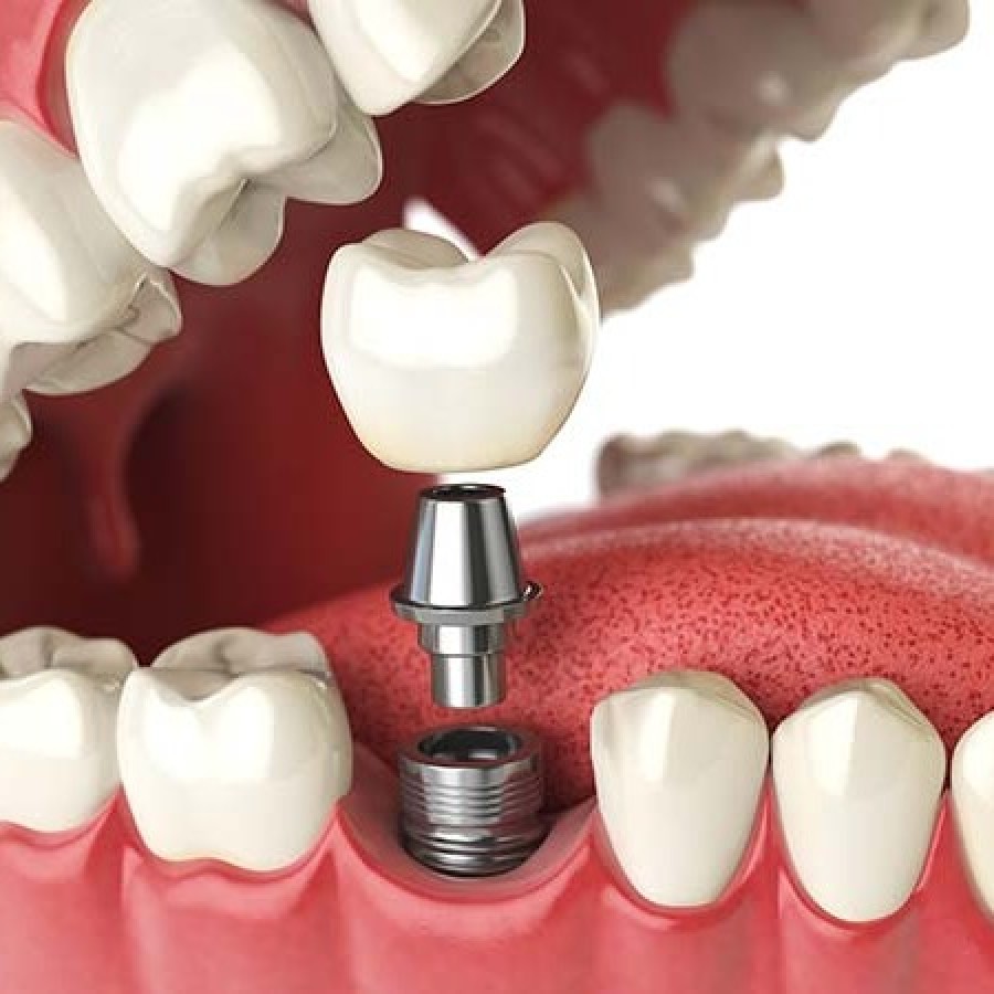 Dental Implants in Astoria, Queens