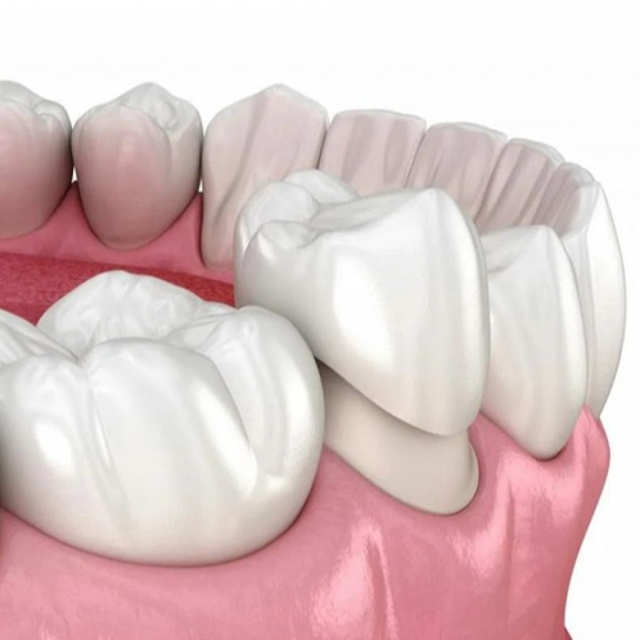 Porcelain and Zirconia Dental Crowns NYC
