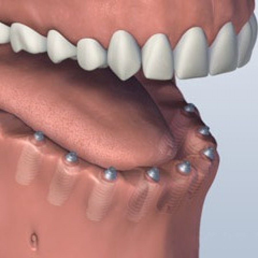FULL MOUTH DENTAL IMPLANTS