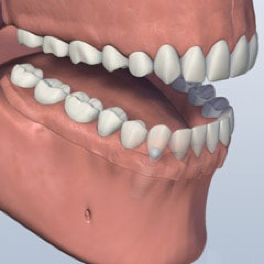 FULL MOUTH DENTAL IMPLANTS