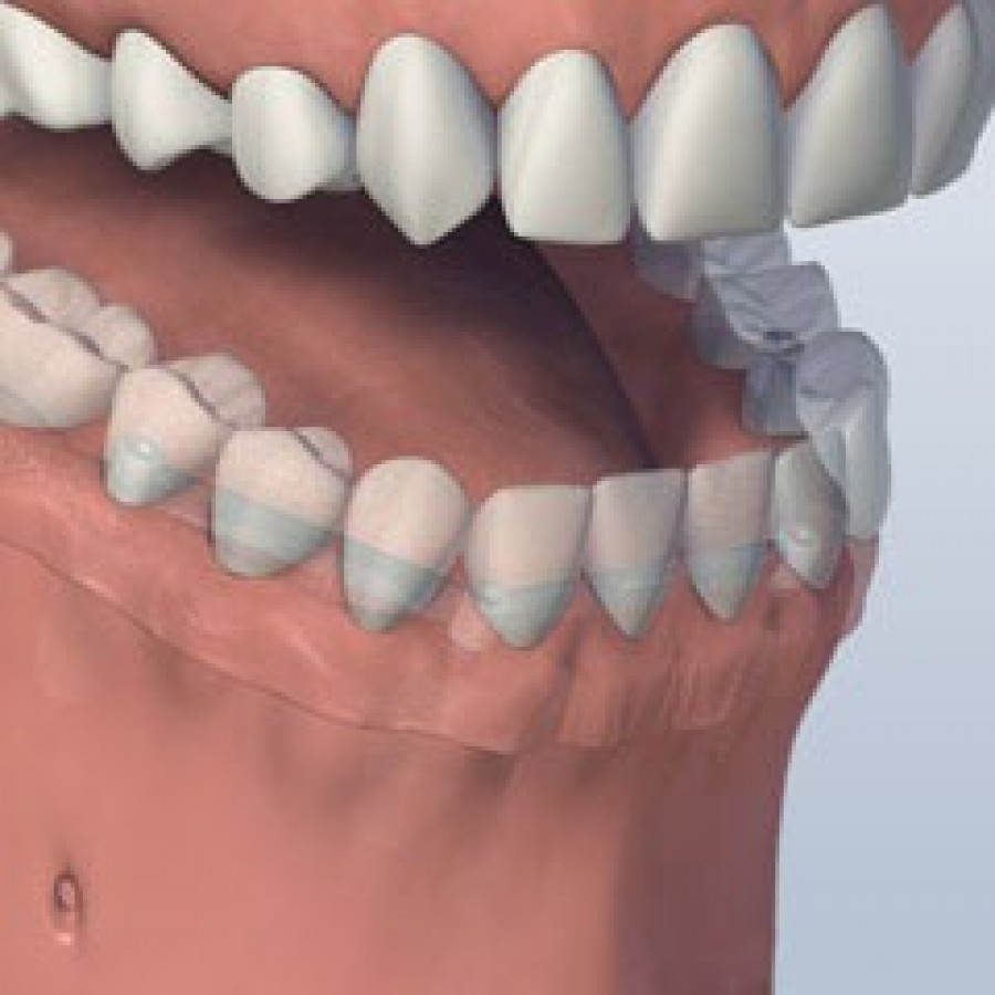 FULL MOUTH DENTAL IMPLANTS