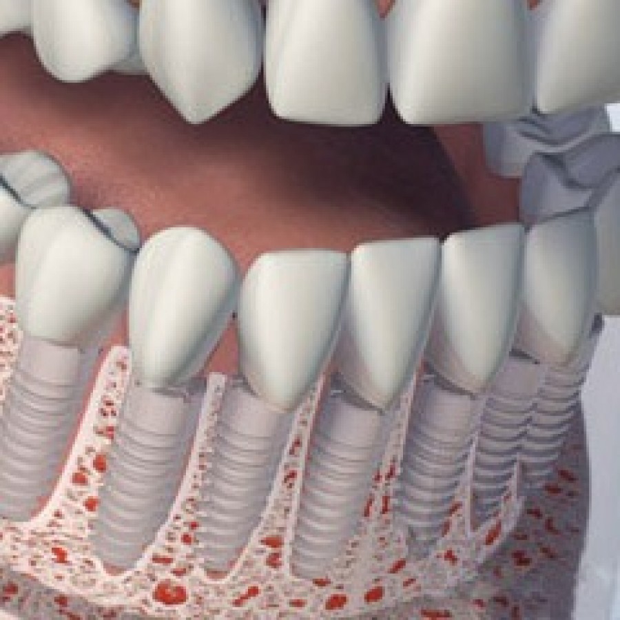 FULL MOUTH DENTAL IMPLANTS