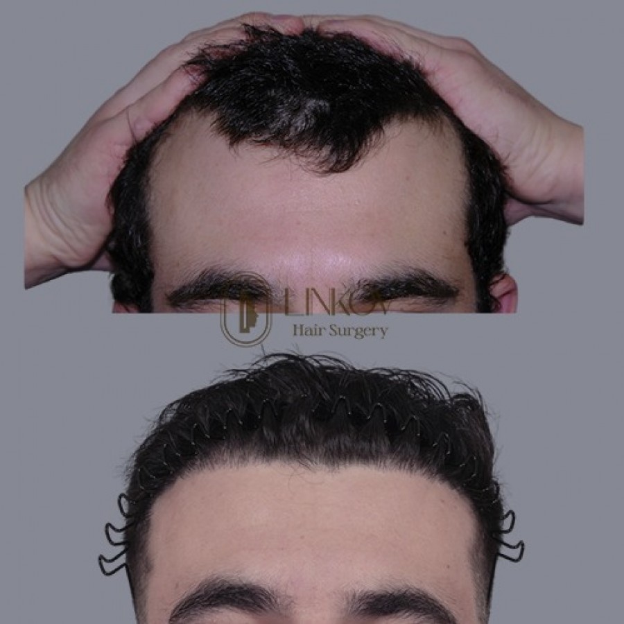 NYC Male Hair Loss Treatments