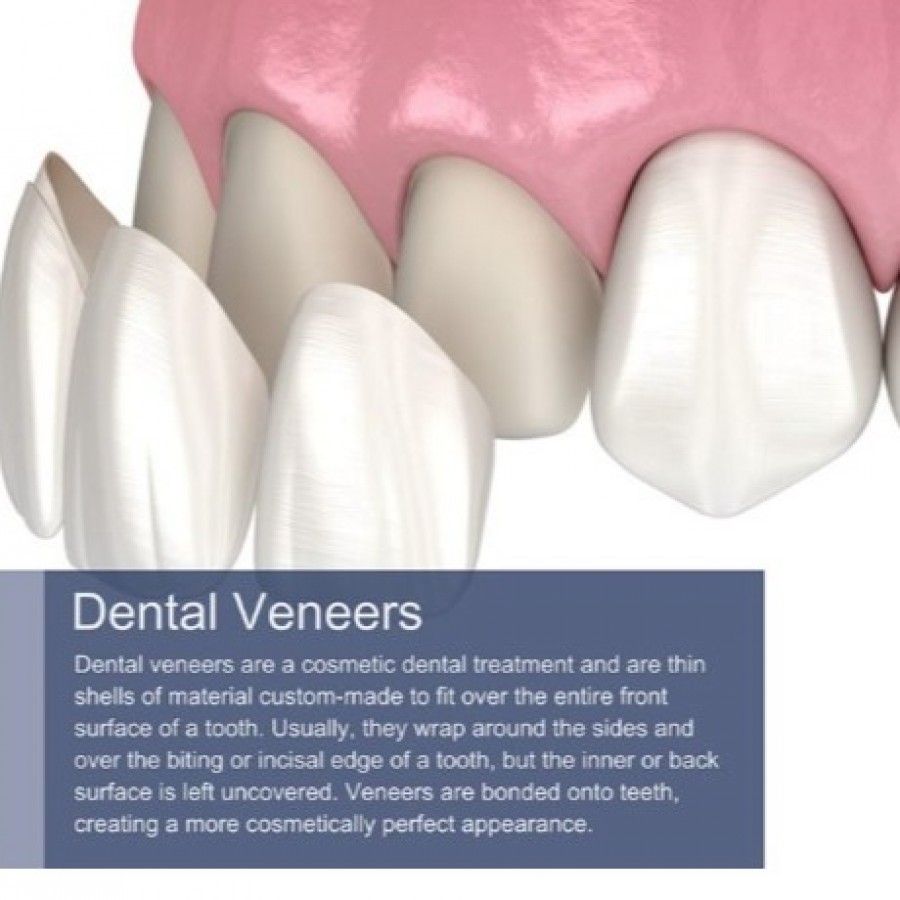 Porcelain Veneers Teeth in NYC