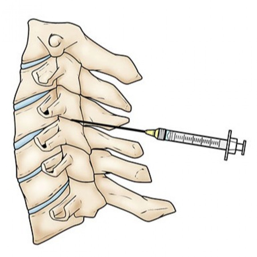 Lumbar Epidural Steroid Injection in NYC