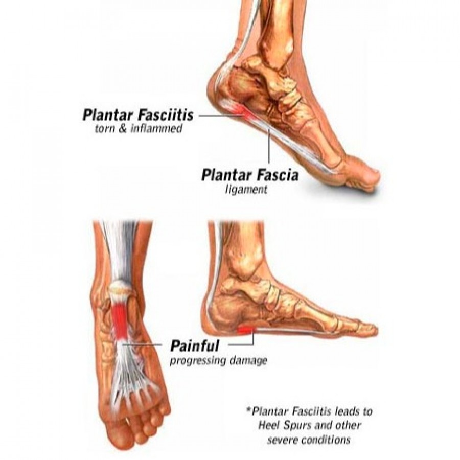 Plantar fasciitis treatment
