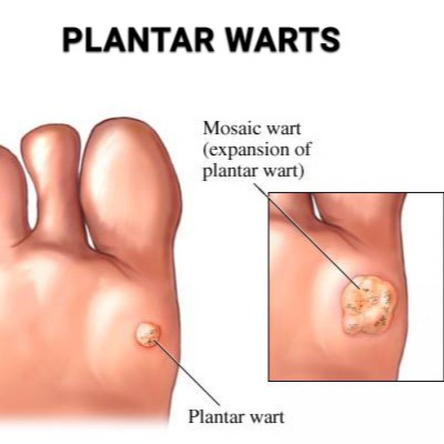 Plantar wart treatment