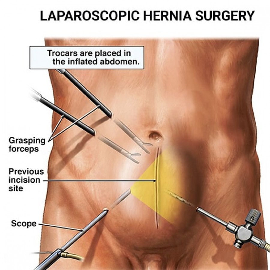 Laparoscopic Hernia Surgery