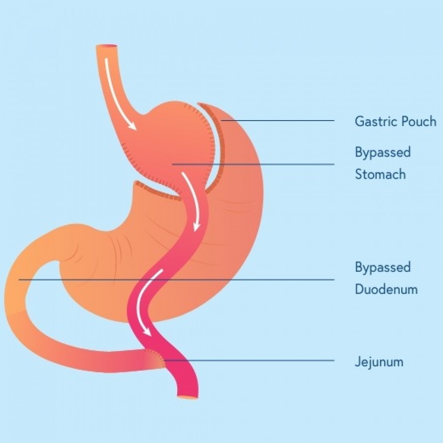Weight Loss Surgery in New Jersey