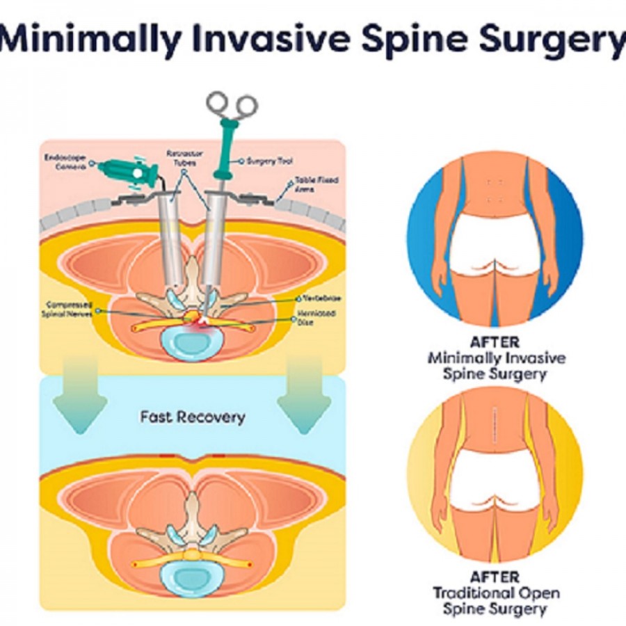 Minimally invasive spine surgery