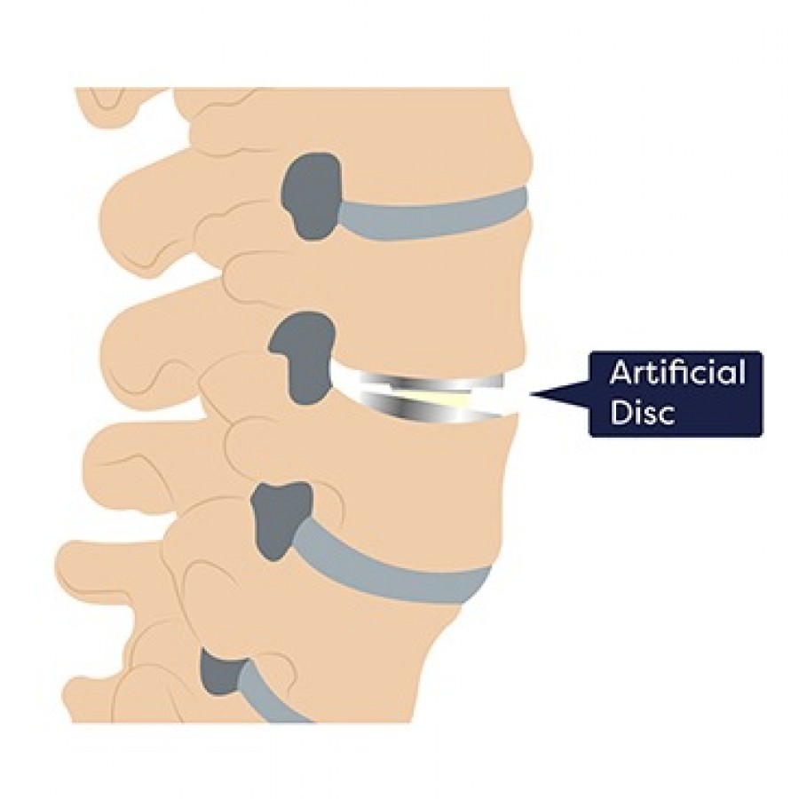 Artificial Disc Replacement Surgery NJ