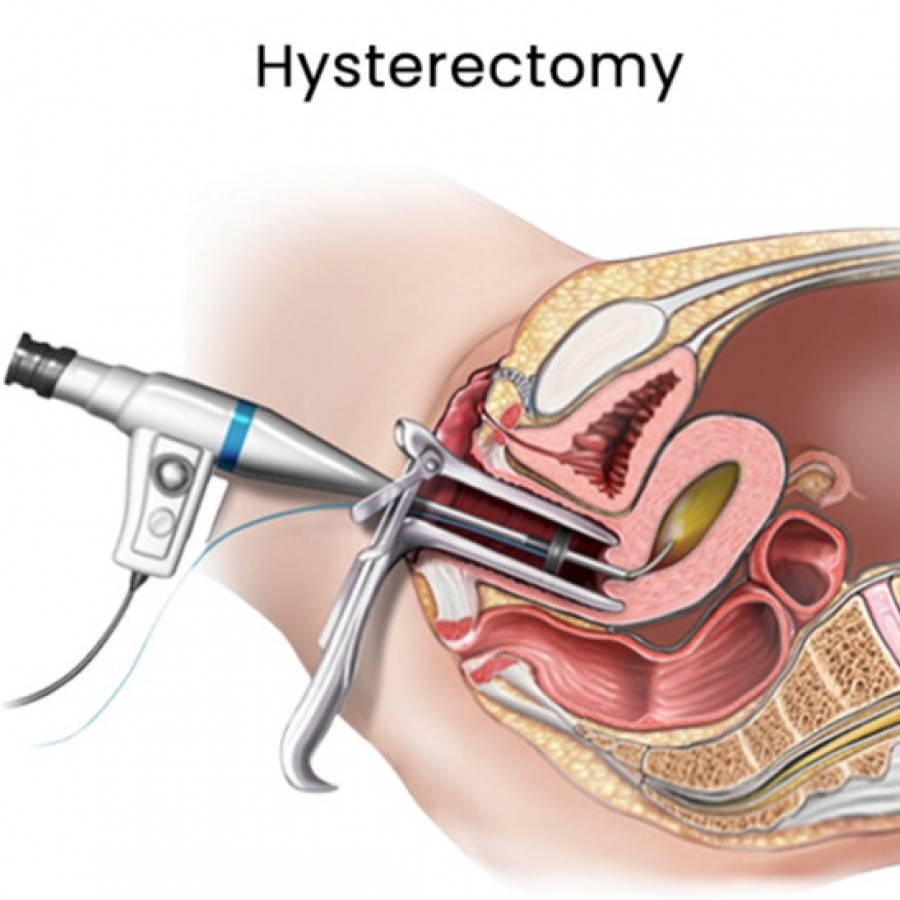 Uterine Fibroid Removal Surgery in Downtown Brooklyn, NY