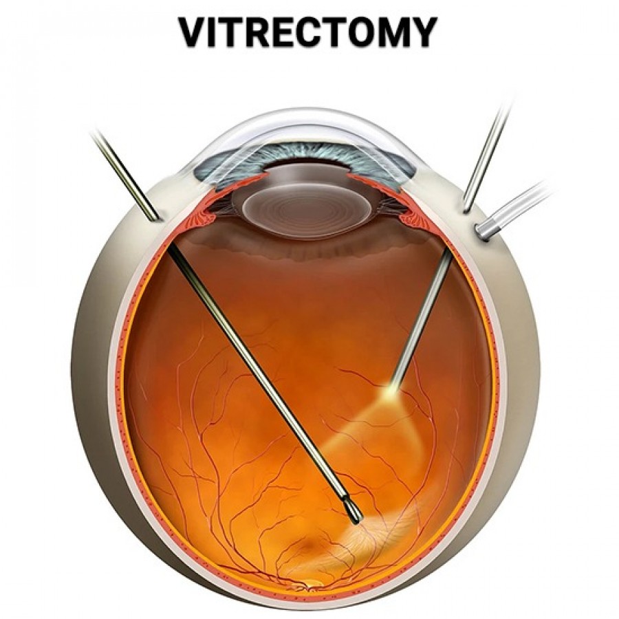 Vitrectomy in NY