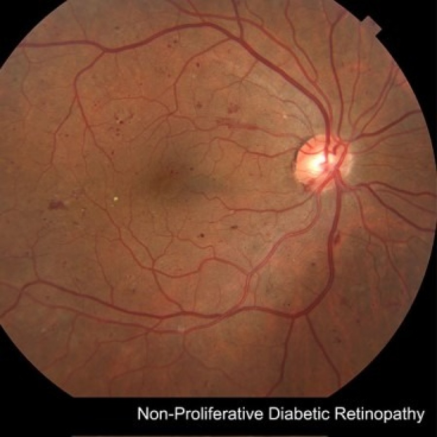 Diabetic Retinopathy
